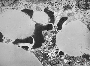 Whipple disease Whipple disease